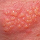 Illustration for article titled obat herpes alami